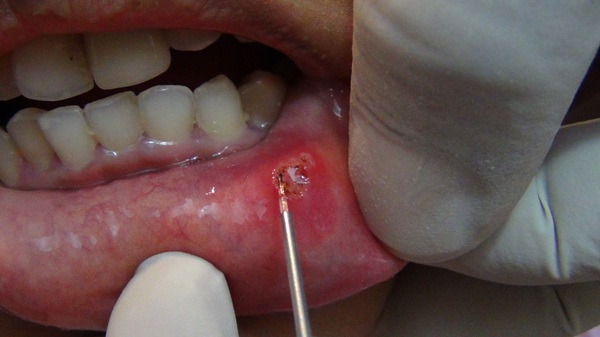 Mouth Ulcer treatment with Laser
